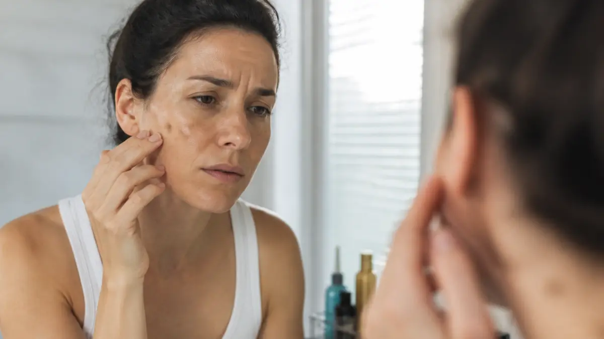 Pigmentvlekken: oorzaken, preventie en cosmetische oplossingen